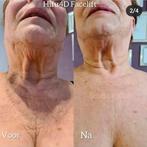 Hifu Facelift, huidverjonging, Ophalen of Verzenden, Nieuw, Gehele gezicht