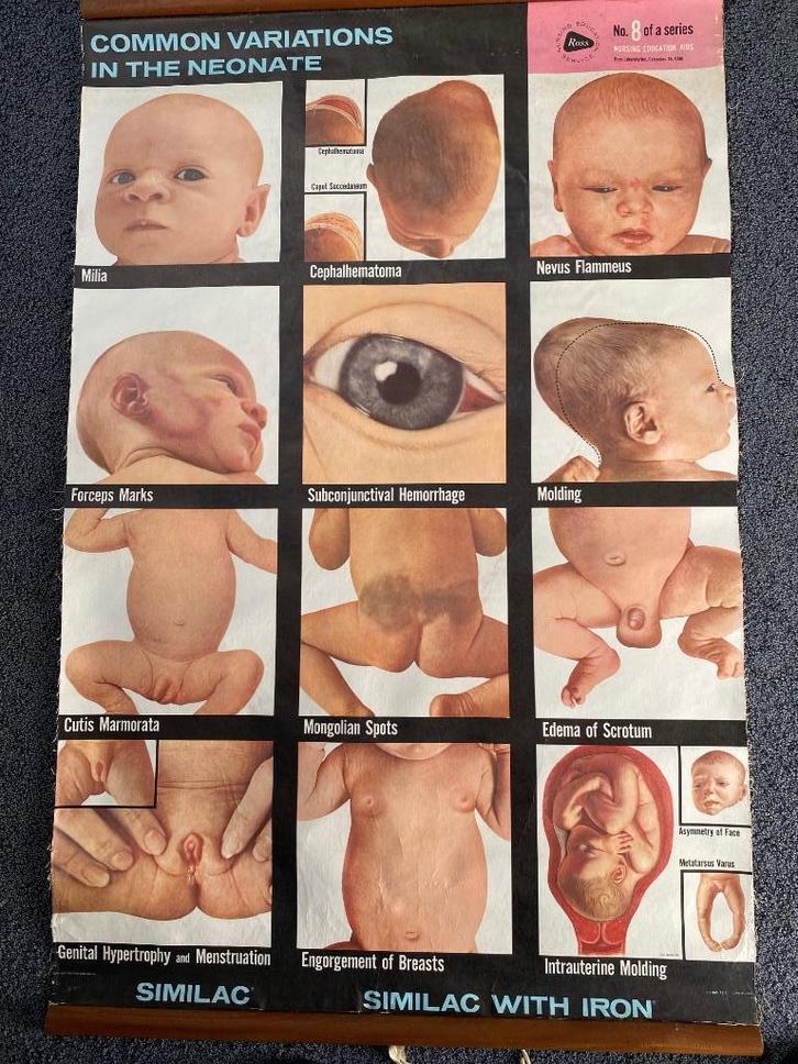 Medische schoolplaat Common variations in the neonate 1961, Antiek en Kunst, Antiek | Schoolplaten, Natuur en Biologie, Ophalen of Verzenden