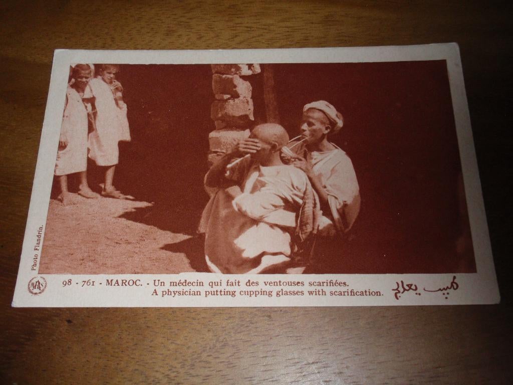 Cupping Scarificatie Medicijnman Marokko, Verzamelen, Ansichtkaarten | Buitenland, Verzenden, 1920 tot 1940, Ongelopen, Buiten Europa