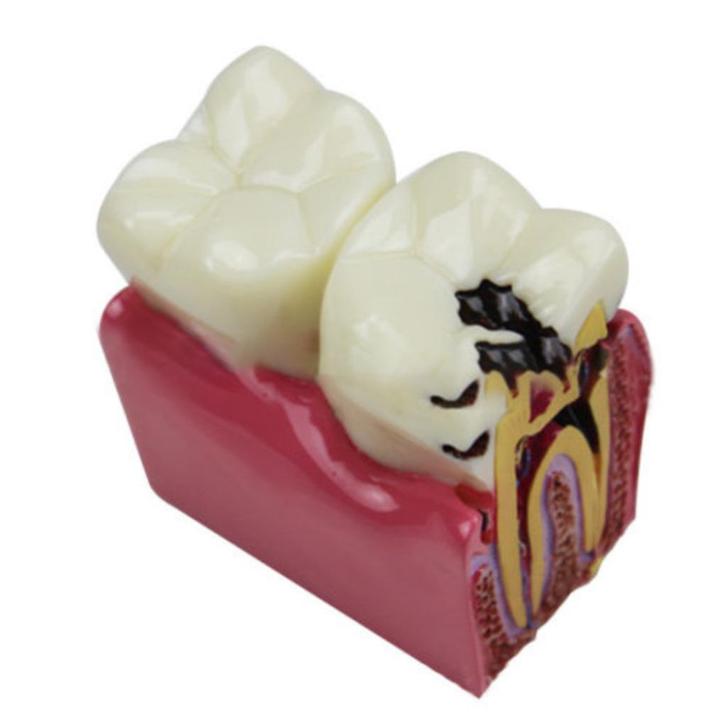 Kies Menselijk Anatomie Model School Tanden Caries Tandarts, Diversen, Schoolbenodigdheden, Nieuw, Verzenden