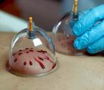 Hijama therapeute amsterdam west, Sport en Fitness, Gezondheidsproducten en Wellness, Verzenden, Nieuw