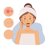 Modellen gezocht met acne of mee-eters – gratis behandeling, Variabele uren, Overige niveaus, Starter, Overige vormen
