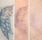 Modellen gezocht Tattoo Removal 15 november, Overige niveaus, Starter, Overige vormen