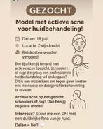 Acne model