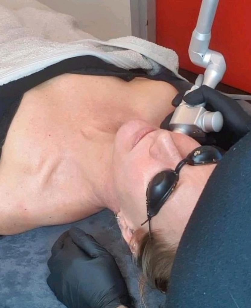 Facelift & Ooglidcorrectie met CO₂ Laser ✨, Ophalen of Verzenden, Nieuw, Zwart, Gehele gezicht
