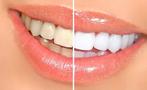 Tanden bleken met Opalescence bleekgel!, Sieraden, Tassen en Uiterlijk, Uiterlijk | Cosmetica en Make-up, Nieuw, Verzenden