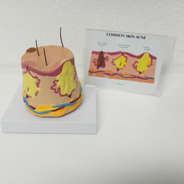 Anatomie huidmodel acne, dermatologie beschikbaar voor biedingen