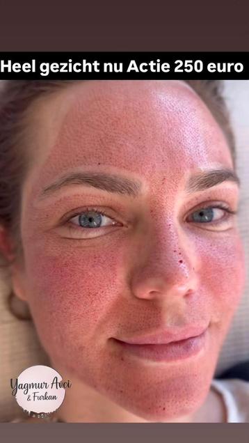 Plazma Pen Behandeling  beschikbaar voor biedingen