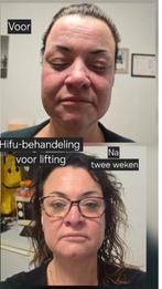 lifting behandeling met (Hifu-ultraformer 3), Ophalen of Verzenden, Overige typen