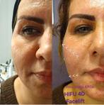 Hifu therapie huidverjonging, Ophalen of Verzenden, Gehele gezicht