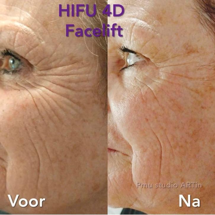 Hifu therapie huidverjonging, Sieraden, Tassen en Uiterlijk, Uiterlijk | Gezichtsverzorging, Gehele gezicht, Ophalen of Verzenden