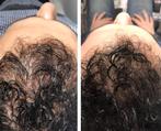 Mesotherapie haar meso haren