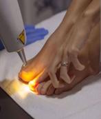 Last van schimmel nagels? Laser behandeling vanaf 24 euro, Ophalen, Nieuw