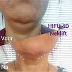 Hifu therapie huidverjonging, Ophalen of Verzenden, Gehele gezicht