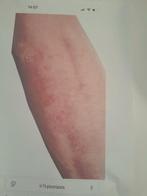 Kruiden preparaat tegen psoriasis, Boeken, Gezondheid, Dieet en Voeding, Ophalen of Verzenden, Kruiden en Alternatief