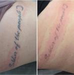 Modellen gezocht Tattoo Removal, Vacatures, Overige niveaus, Starter, Overige vormen