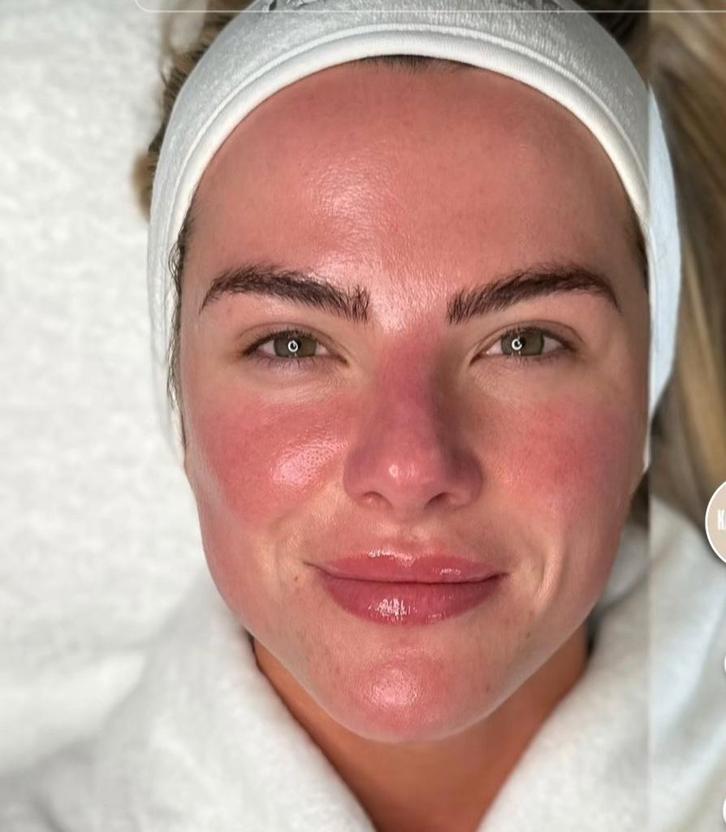 Facial  behandeling micro needling bio peelingen€40, Sieraden, Tassen en Uiterlijk, Uiterlijk | Gezichtsverzorging, Ophalen of Verzenden