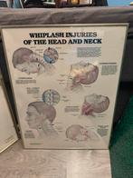 Ingelijste medische plaat, Antiek en Kunst, Antiek | Schoolplaten, Ophalen, Natuur en Biologie